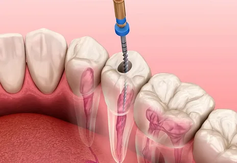 Endodonti (Kanal Tedavisi)